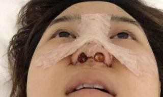 鼻子整形需要多少钱 鼻子整形需要多少钱